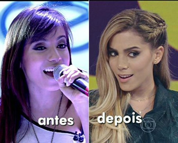 Anitta antes e depois da cirurgia!